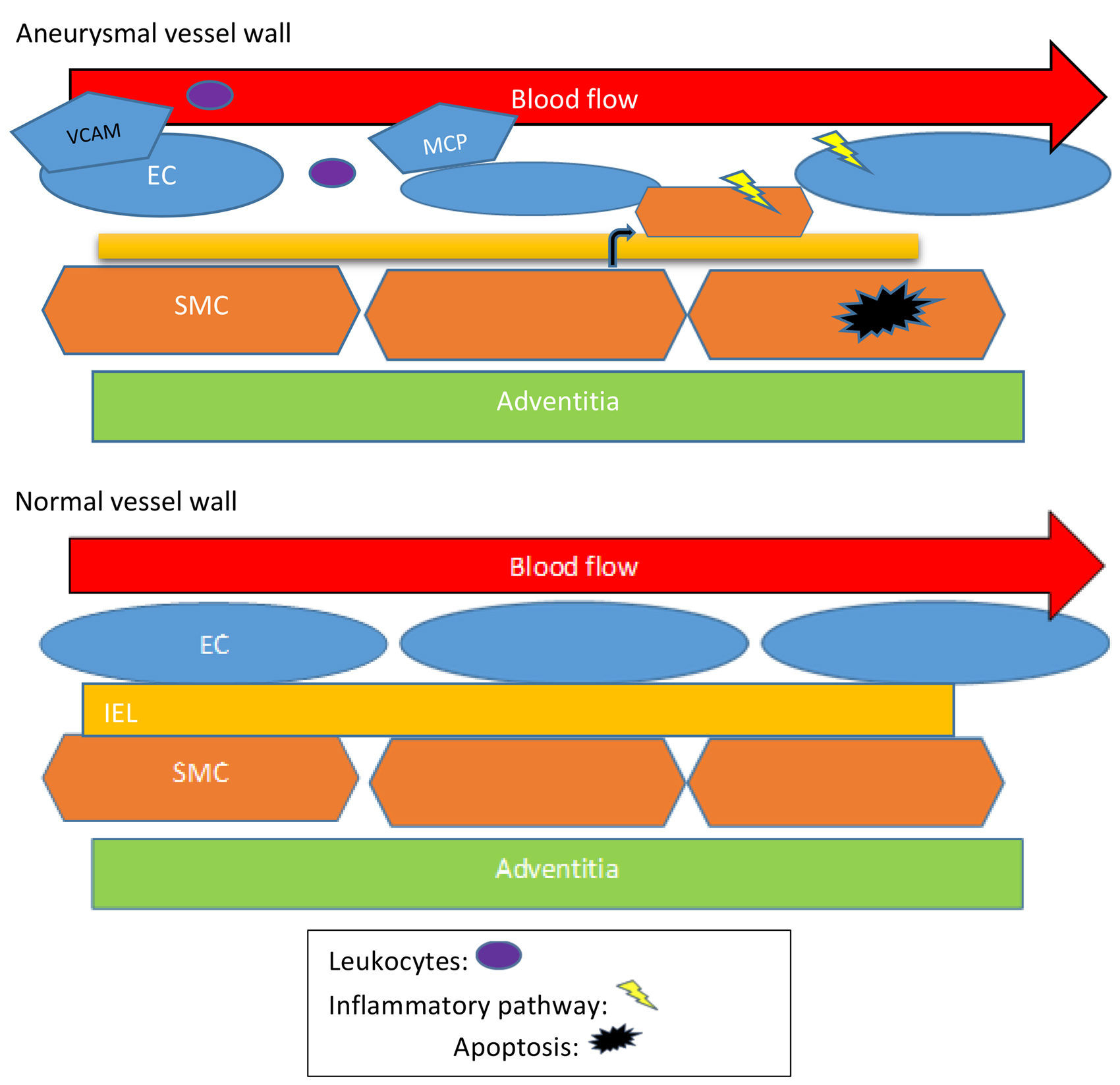 剪切應(yīng)力與動(dòng)脈瘤：綜述